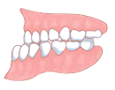 下顎前突・反対咬合